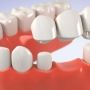 Tipuri de punti dentare: caracteristici, avantaje, preturi