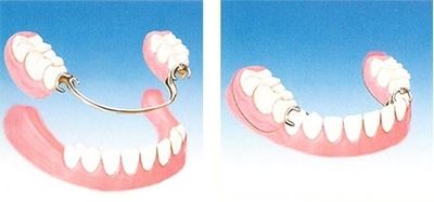 Proteza dentara scheletata: caracteristici si avantaje