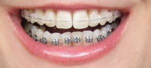 Aparat dentar invizibil