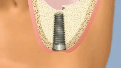 Sinus lift