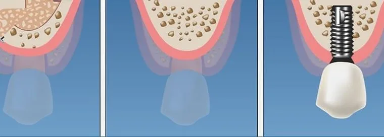 Operatia de sinus lift pentru inserarea implantului dentar