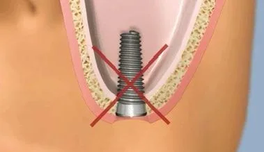 Sinus lift