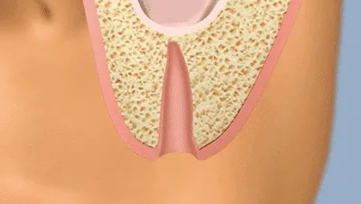 Sinus lift