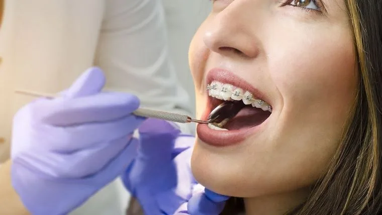 Aparat dentar metalic versus aparat dentar ceramic versus aparat dentar safir