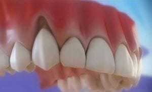 Grefa gingivala