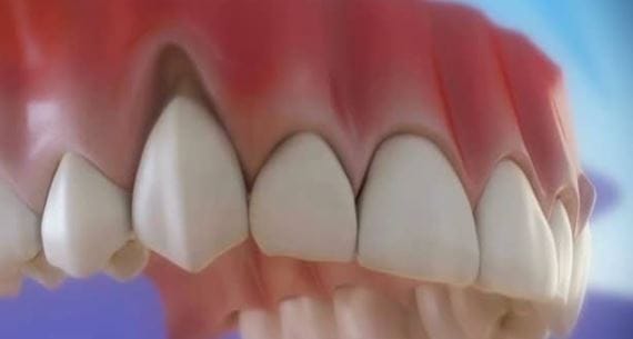 Gingivita – semne timpurii, cauze si tratamente recomandate