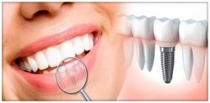 Implant dentar pardontoza