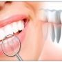 Implanturile dentare in cazul parodontozei