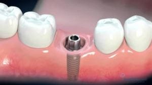 Implant dentar parodontoza