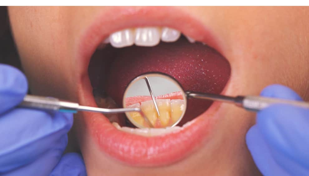 Implant dentar parodontoza