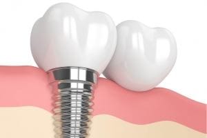 implant dentar titan