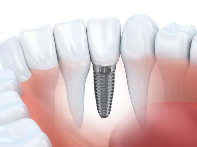 implant dentar titan