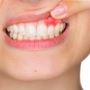 Abcesul dentar: cauze, cum se recunoaste si tratament