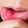 Afte bucale: cauze, simptome, tratament