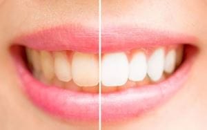 Albirea profesionala a dintilor