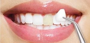 fetete-dentare-sau-coroane