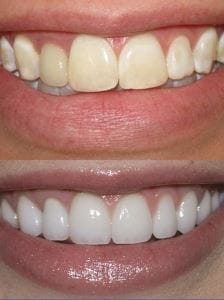 Fatete dentare ceramica
