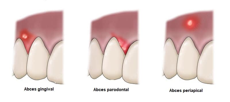 abces-dentar-tipuri