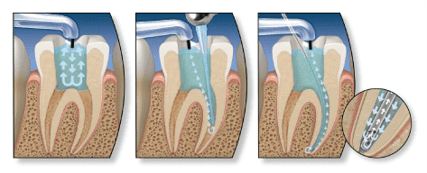 procedura endodontica