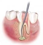 endodontie
