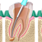 tratament endodontic