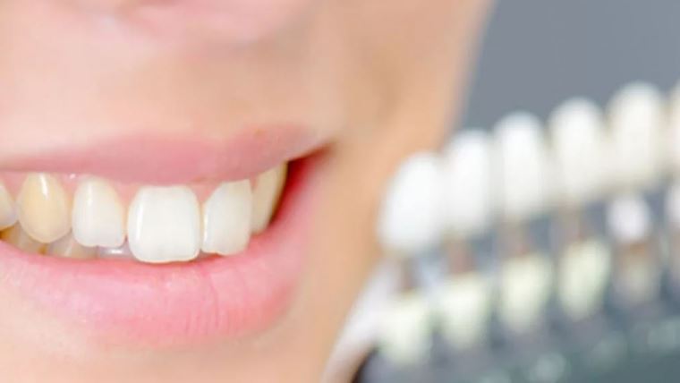 Discromia dentara: cauzele patarii dintilor
