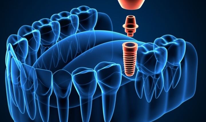 Avantajele implantului dentar ghidat digital