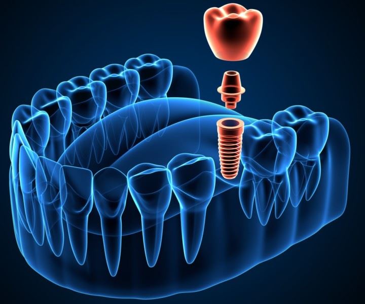 Avantajele implantului dentar ghidat digital