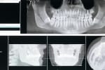 Adiția de os: când este necesară și cum o poți preveni - Miko Dental