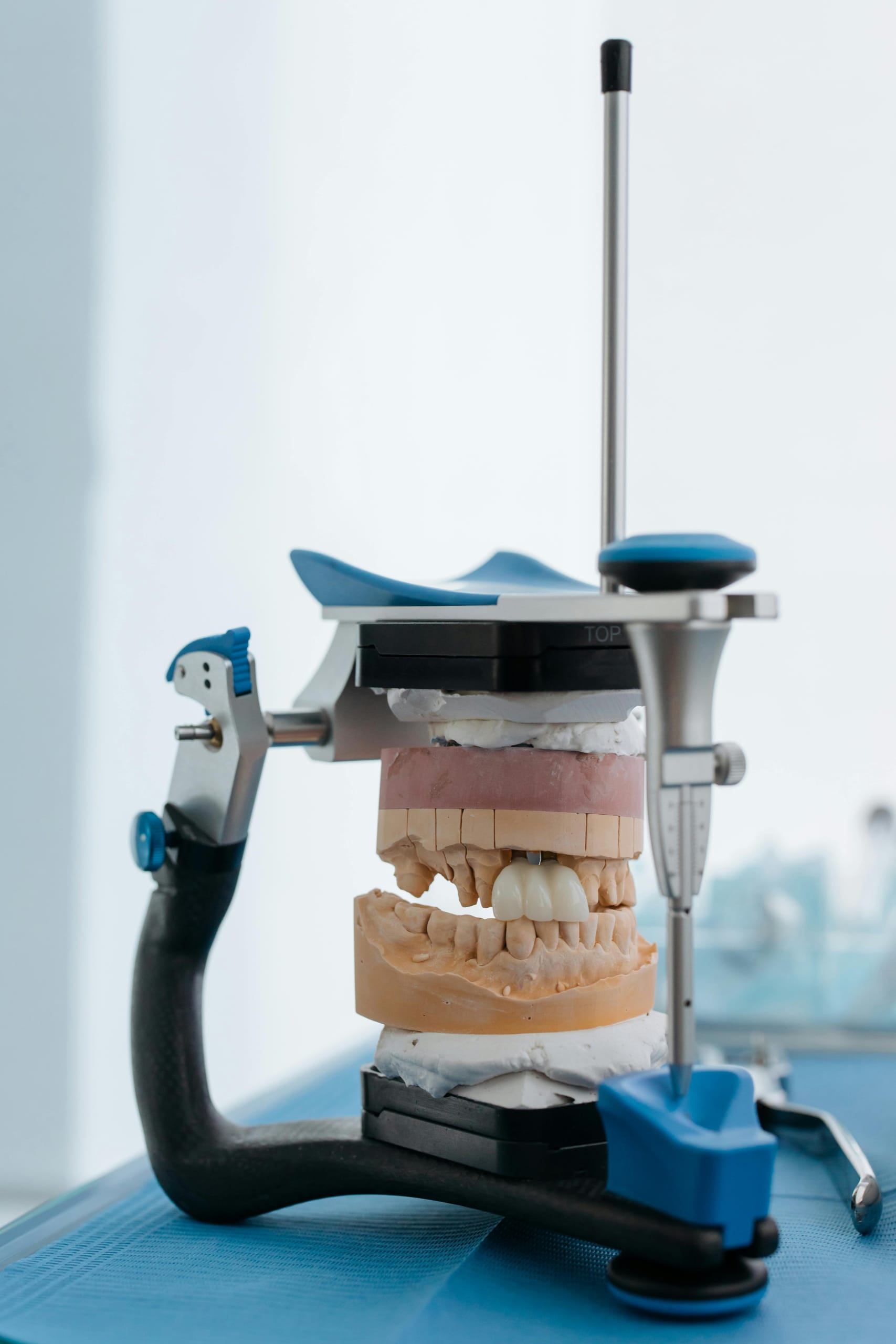 Adiția de os: când este necesară și cum o poți preveni - Miko Dental