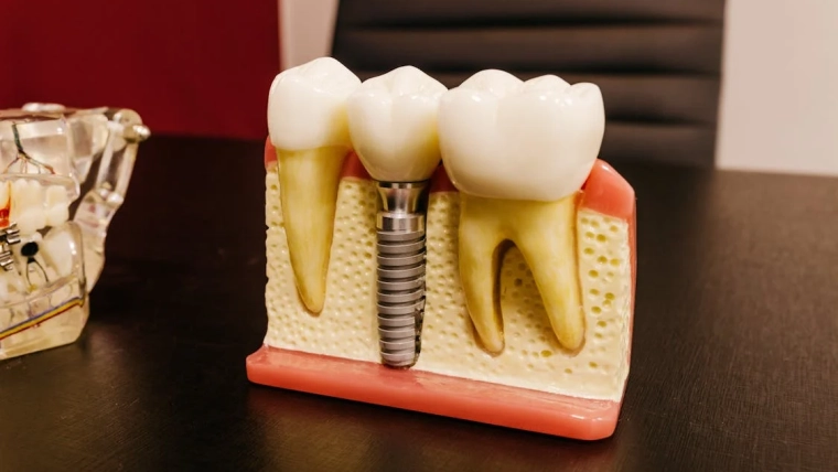 Cauzele pierderii unui implant dentar și cum pot fi prevenite