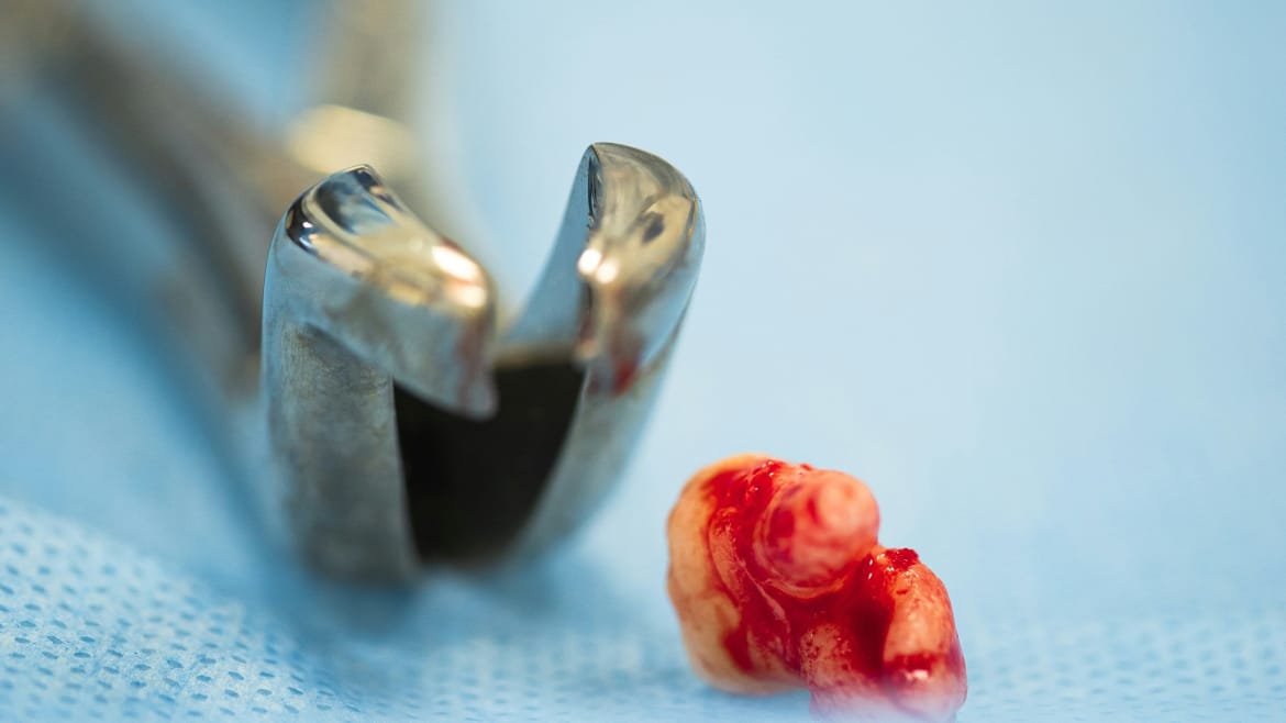 Recuperarea dupa extractia unei masele – ce poti manca si cum te ingrijesti