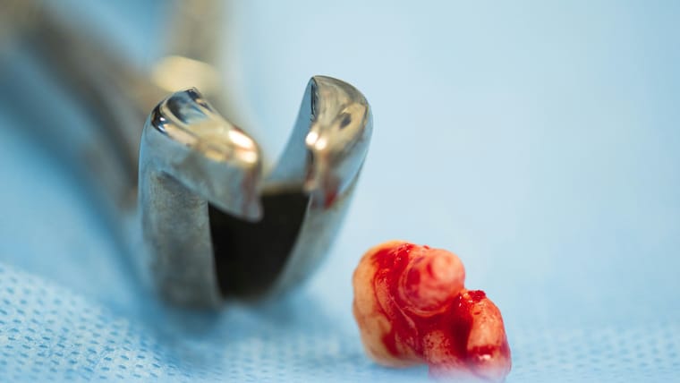 Recuperarea dupa extractia unei masele – ce poti manca si cum te ingrijesti