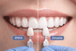 Fatete EMAX vs zirconiu – care este alegerea corecta in functie de caz - Miko Dental