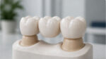 punte dentara pret tipuri si alternative