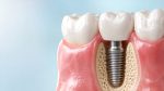 Coroana dentară pe implant – când se montează și cum se întreține corect