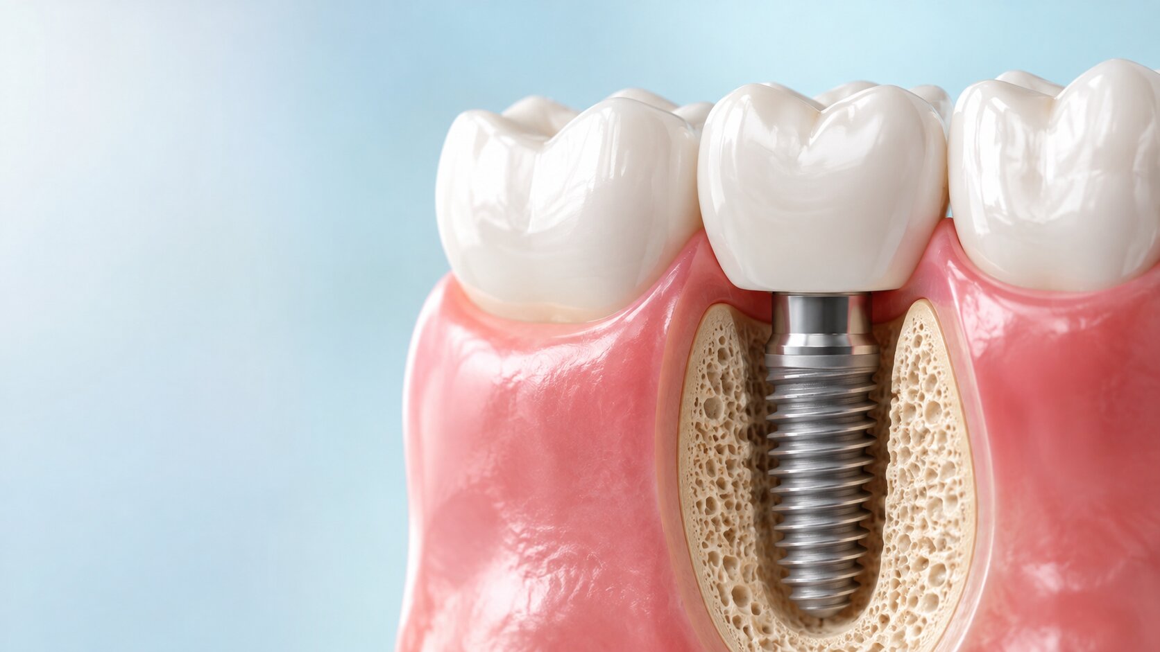 Coroana dentară pe implant – când se montează și cum se întreține corect