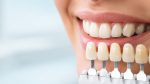 Cum alegi culoarea coroanelor și lucrărilor dentare pentru un rezultat natural