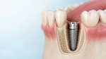 Implant dentar imediat după extracție – avantaje, riscuri și când este posibil