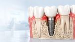 Periimplantita – cauze, simptome și tratament pentru salvarea implantului dentar