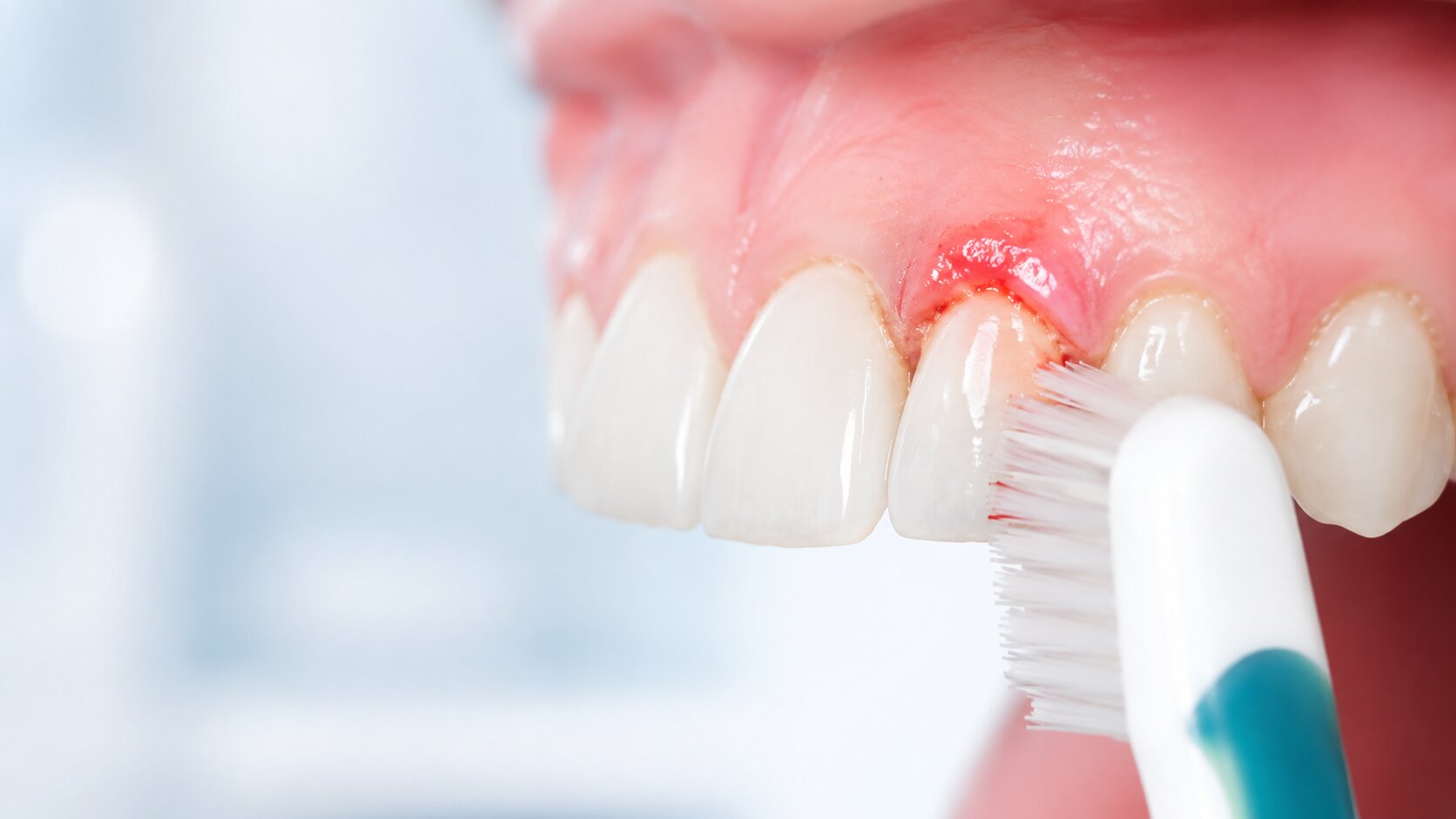 De ce sângerează gingiile la periaj și când trebuie să mergi la medic?