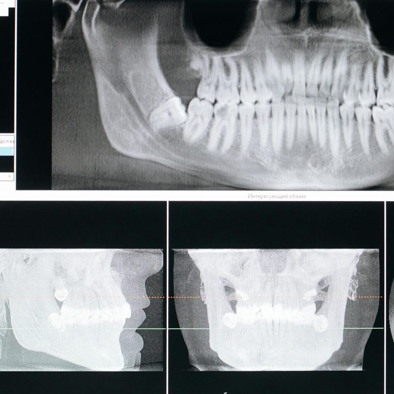 Adiția de os: când este necesară și cum o poți preveni - Miko Dental
