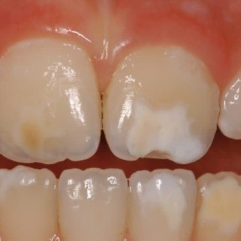 Demineralizarea si fluorizarea la copii