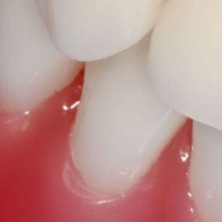 Cresterea anormala a gingiilor