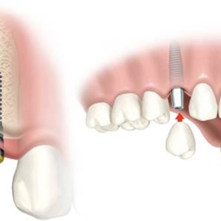 Tipuri de implant dentar