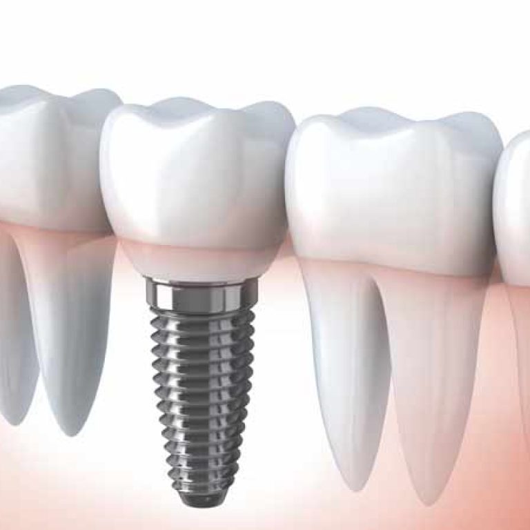 Etape implant dentar