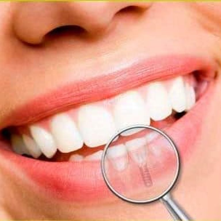 Avantajele implantului dentar