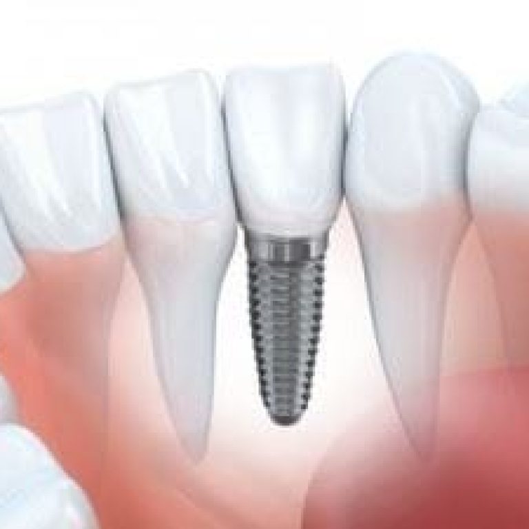 Recuperarea dupa implant dentar