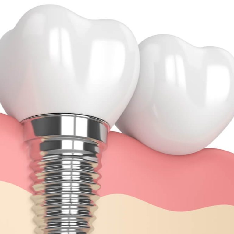 implant dentar titan