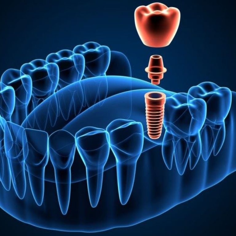 Implantologia ghidata